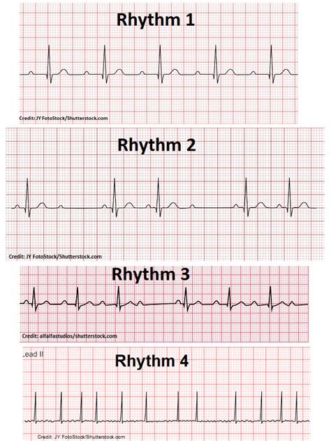 ekg interpretation practice.